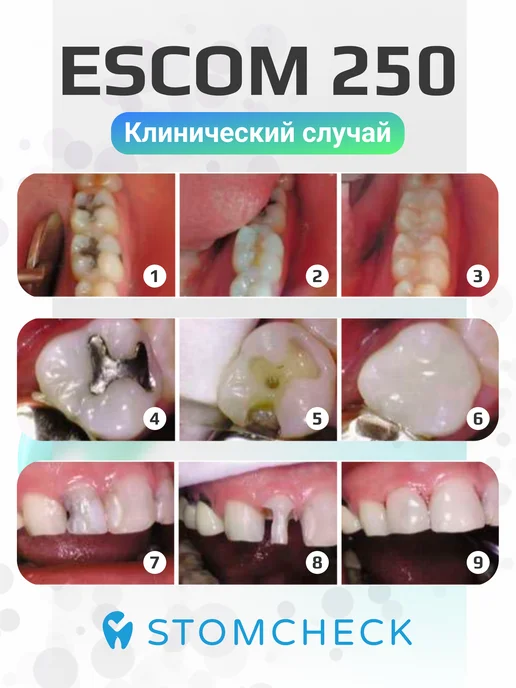 spident EsCom250 (5 шпр) набор пломбировочный + бонд и протравка, 7 шт, фото 8