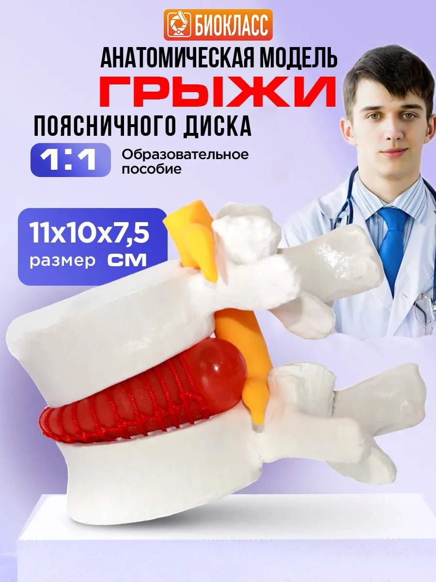 Анатомическая модель грыжи поясничного диска 1:1
