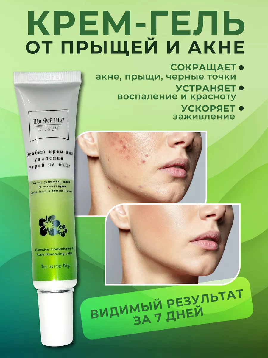 Крем от прыщей - акне и...