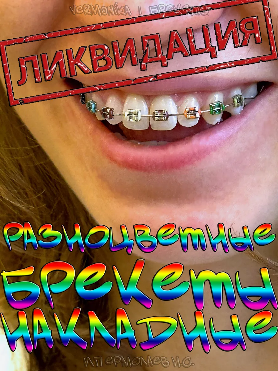 Брекеты накладные...