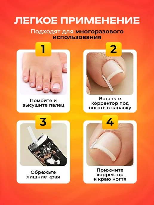 От вросших ногтей на ногах / набор для педикюра Вросший ноготь корректор, белый, фото 2